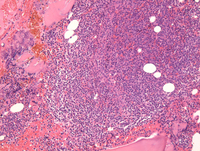 Myeloma