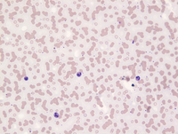 Myeloma