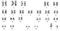 APL-cytogenetics