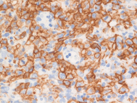 Lymphomatoid granulomatosis-CD20