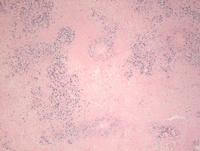 Lymphomatoid granulomatosis-EBER