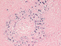 Lymphomatoid granulomatosis