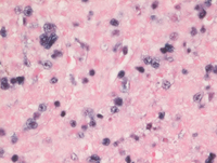 Lymphomatoid granulomatosis-EBER