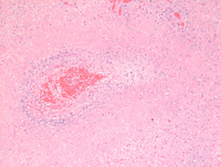 Lymphomatoid granulomatosis