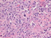 Lymphomatoid granulomatosis-HE