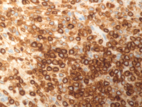 Splenic marginal zone lymphoma-BCL2