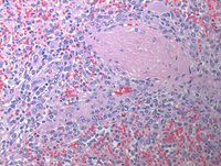 Splenic-marginal-zone-lymphomaHE