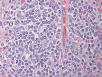 Splenic marginal zone lymphoma-HE