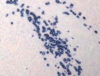 Splenic-marginal-zone-lymphomaKappa-ISH