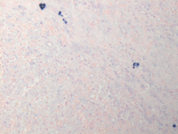 Splenic marginal zone lymphoma-Lambda ISH