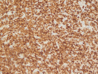 Mantle cell lymphoma-BCL2