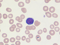 Mantle cell lymphoma blood