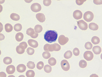 Mantle cell lymphoma-Blood