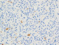 Mantle cell lymphoma-Cyclin-D1