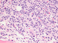 Mantle cell lymphoma