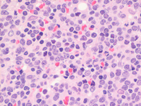 Mantle cell lymphoma-HE