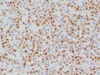 Mantle cell lymphoma-SOX11