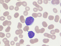 Mantle cell lymphoma