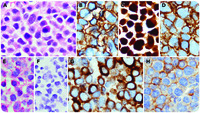 Aberrant T-cell antigen expression in a plasma cell neoplasm