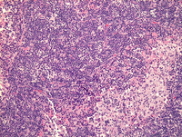 Rosai-Dorfman disease