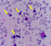 Peripheral blood smear with too many NRBCs 1