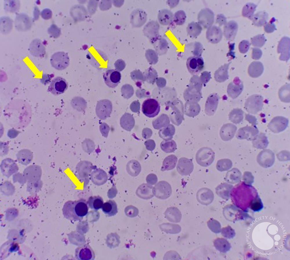 Peripheral blood smear with too many NRBCs 1