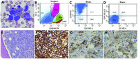 NUT midline carcinoma with leukemic presentation mimicking CD34-positive acute leukemia