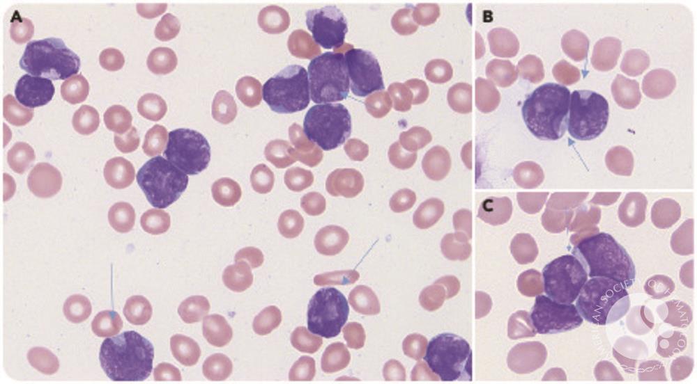 Cuplike nuclear morphology in pediatric B-cell acute lymphoblastic leukemia