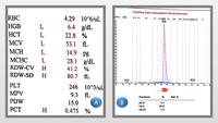 HbH disease with teardrop cell presentation in PBS