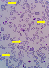 HbH disease with teardrop cell presentation in PBS