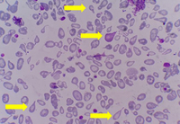 HbH disease with teardrop cell presentation in PBS