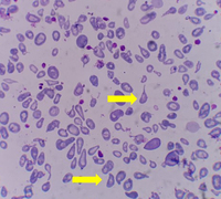 HbH disease with teardrop cell presentation in PBS