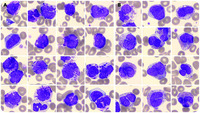 Atypical basophilia