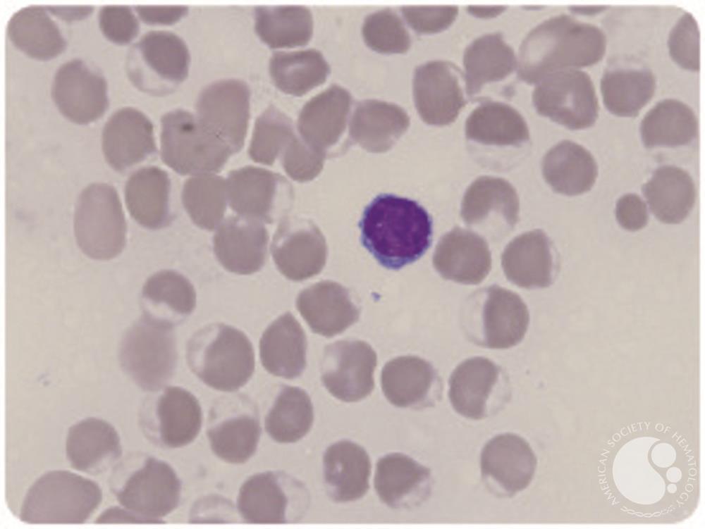 Rasburicase-induced hemolytic anemia in previously undiagnosed G6PD deficiency