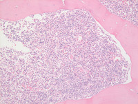 Myeloid Neoplasm-GATA2-proband