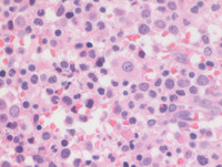 Myeloid Neoplasm-GATA2-proband