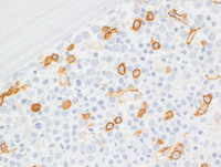 Myeloid Neoplasm-GATA2-proband