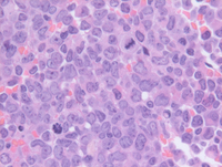 Myeloid-NeoplasmGATA2proband