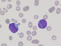 Myeloid Neoplasm-GATA2-Blood