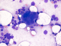 Myeloid-NeoplasmGATA2proband