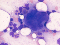 Myeloid-NeoplasmGATA2proband