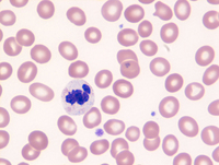 Myeloid Neoplasm-GATA2-Blood