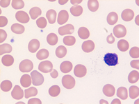 Myeloid-NeoplasmGATA2proband