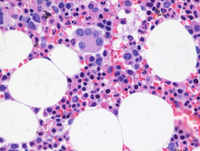 Myeloid-NeoplasmGATA2Pedigree