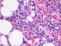 Myeloid-NeoplasmGATA2Pedigree