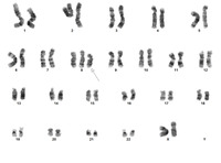 Karyotype-Proband trisomy 8