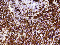 Histiocytic sarcoma-CD163