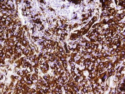 Histiocytic sarcoma-CD163