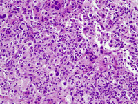 Histiocytic sarcoma-HE