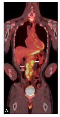 Histiocytic sarcoma-PET